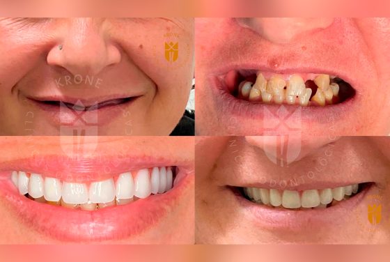 Clínica Krone revoluciona implantes dentários para pessoas de meia idade em Balneário Camboriú
