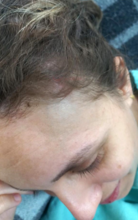 Após piora, mulher atingida por marquise está estável e fora de perigo 2 francine neves marquise cabeca 1